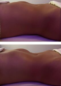 Antes y después abdomen