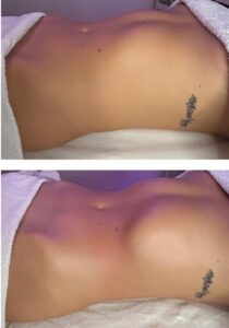 Antes y después abdomen 2