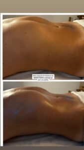Antes y despues abdomen 2