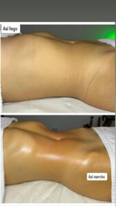 Tratamiento abdomen