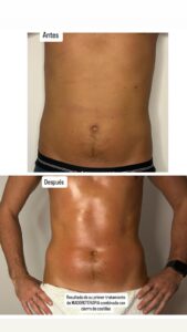 Tratamiento maderoterapia abdomen
