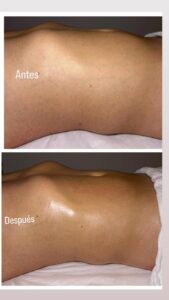 Antes y después de tratamiento de maderoterapia corporal