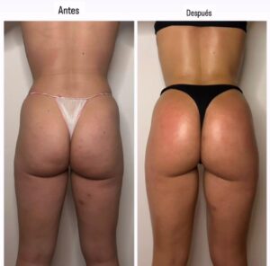 Antes y después de tratamiento de maderoterapia corporal