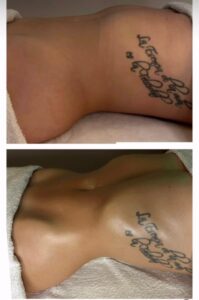 Antes y despues abdomen resultado