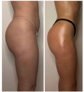 Antes y después de tratamiento de maderoterapia corporal