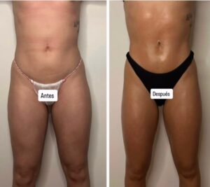 Antes y después de tratamiento de maderoterapia corporal